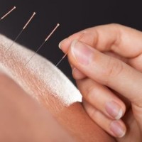 Akunpunktur kan lindre smerter ved blandt andet gigt